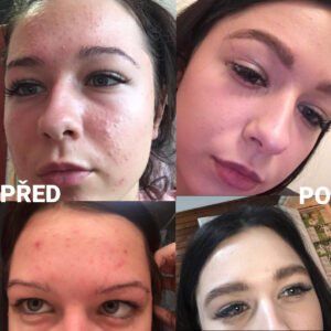 Martina — PŘED a PO 4